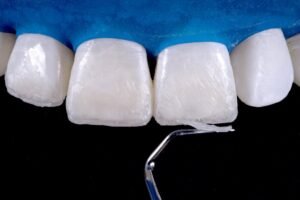Importancia de los Bordes Incisales: Más Allá de la Estética