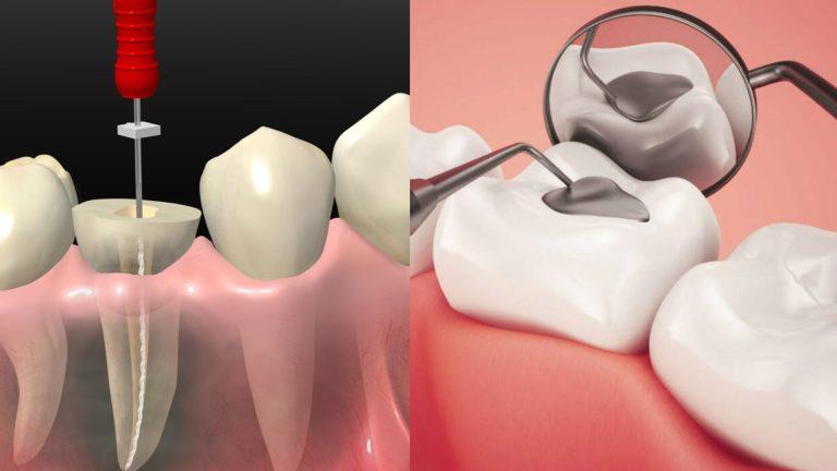 ¿Cómo Saber si Necesitás una Endodoncia o un Empaste?