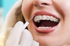 Endodoncia con Brackets: ¿Se Puede Hacer? Todo lo que Necesitás Saber