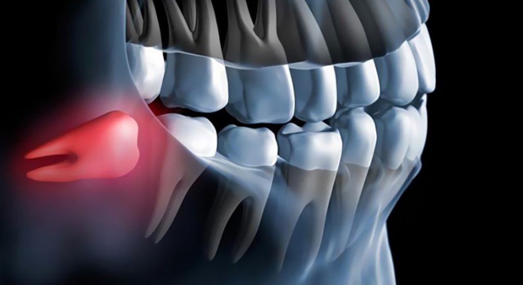 Extracción de Cordales: Lo que Necesitas Saber Antes, Durante y Después