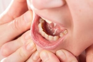Problemas Dentales que Requieren Atención Maxilofacial: Más Común de lo que Creés