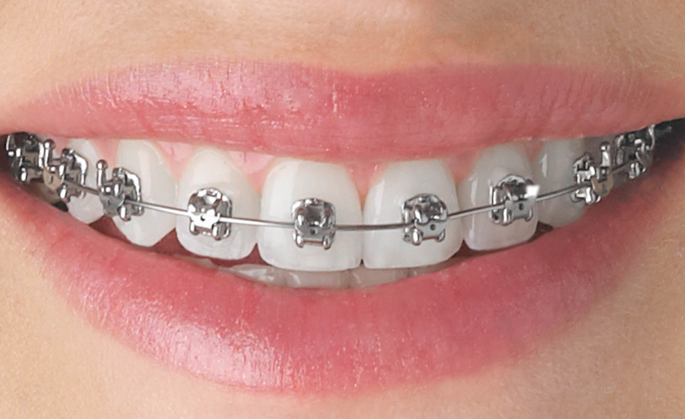 Brackets autoligables