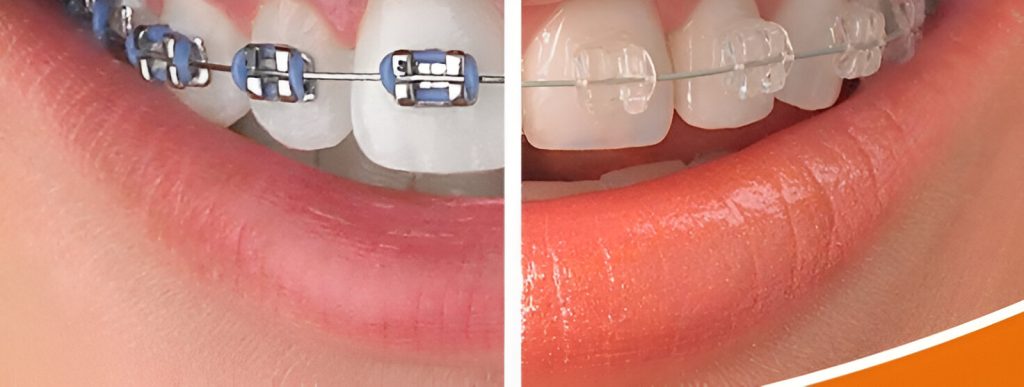 Brackets Estéticos Transparentes vs. Metálicos