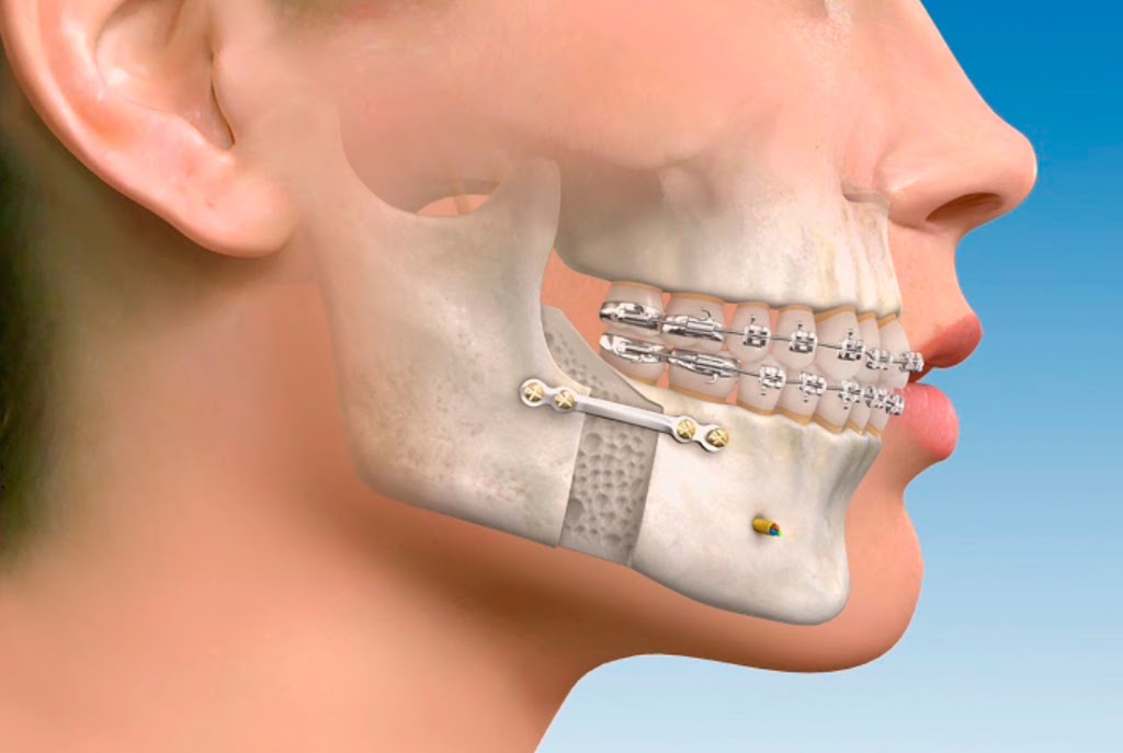 ¿Quién Realiza una Cirugía Maxilofacial?